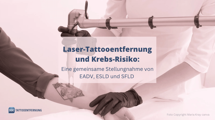 Laser-Tattooentfernung und Krebs-Risiko