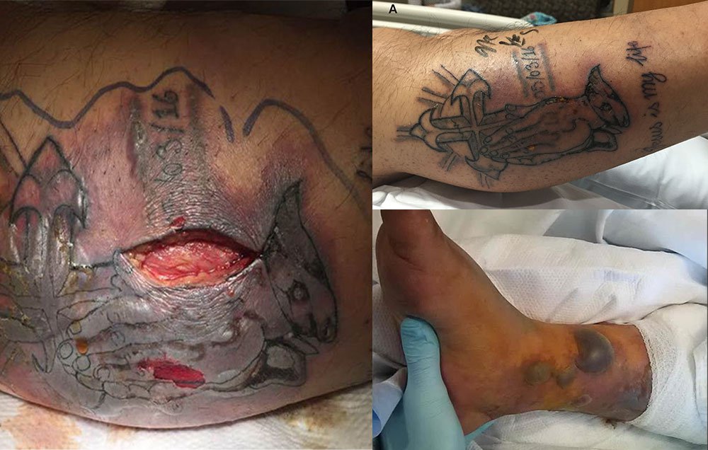 Patient-developed-septic-shock-after-a-new-tattoo-became-infected-in-the-sea-Quelle-BMJ-Case-Reports-Copyright-2017