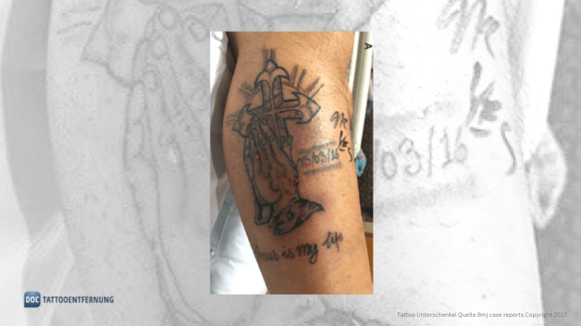 Tod durch Tattoo?