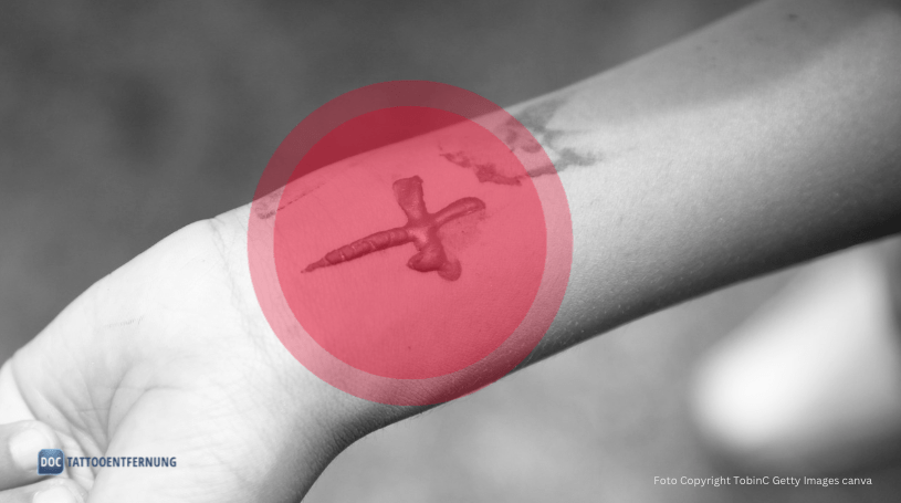 Tattoo-Komplikation Foto Copyright TobinC Getty Images canva for Doc Tattooentfernung 2024