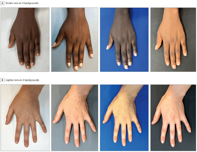 Abbildung 1. Klinische Bilder mit unterschiedlichen Hintergrundfarben Copyright Copyright 2025 American Medical Association, Madison Grinnell, MD et al. DOI 10.1001/jamadermatol.2025.0699