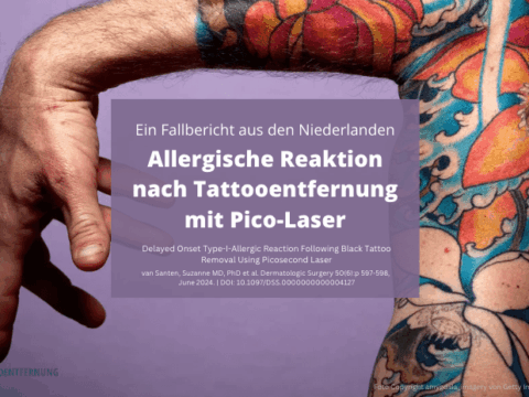 Allergische Reaktion nach Tattooentfernung mit Pico‑Laser Foto Copyright amygdala_imagery von Getty Images Signature canva for Doc Tattooentfernung 2025