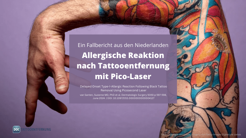 Allergische Reaktion nach Tattooentfernung mit Pico‑Laser