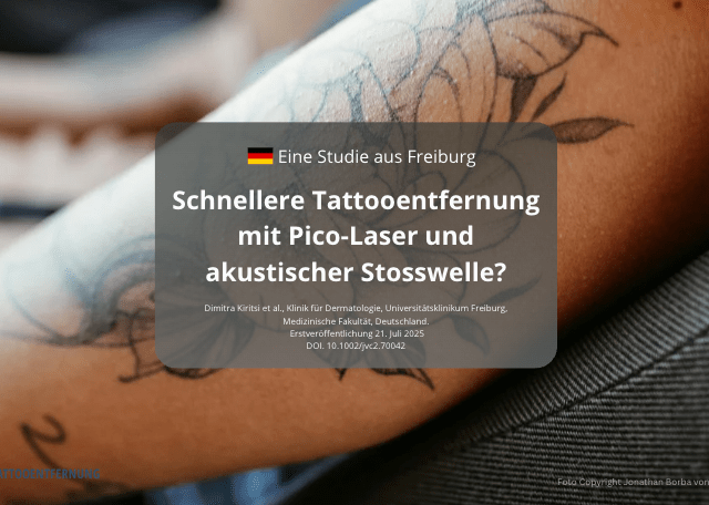 Schnellere Tattooentfernung mit Pico-Laser und akustischer Stosswelle?