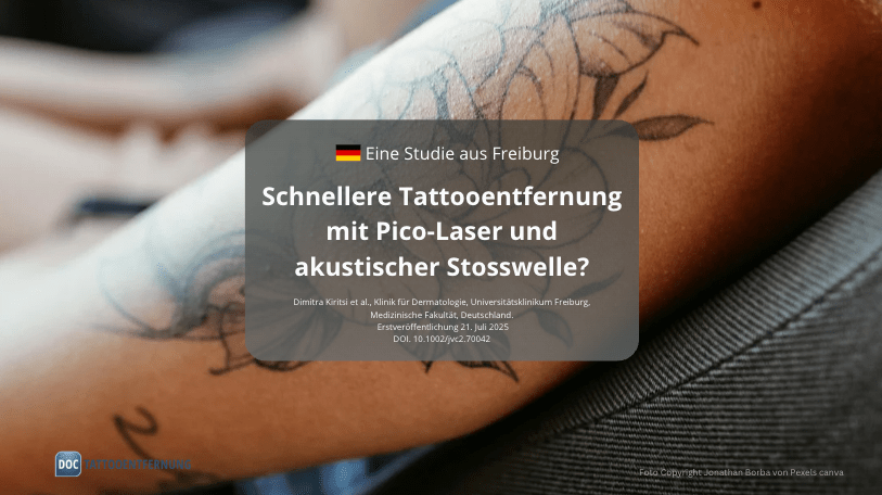 Schnellere Tattooentfernung mit Pico-Laser und akustischer Stosswelle?