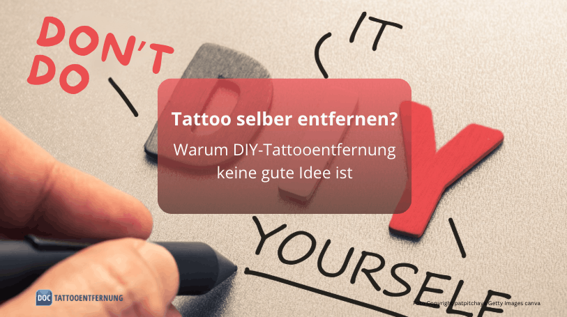 Tattoo selber entfernen? Warum DIY-Tattooentfernung keine gute Idee ist