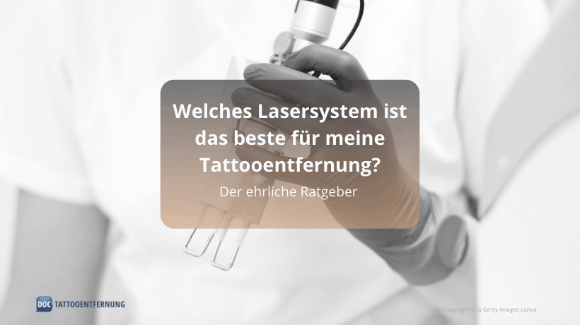 Welches Lasersystem ist das beste für meine Tattooentfernung? Der ehrliche Ratgeber