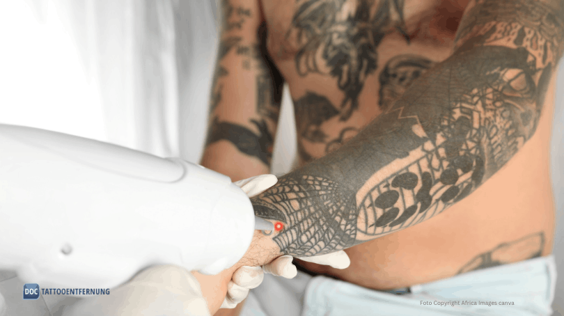 Billiger Laser führt zur Narbe bei der Tattooentfernung Foto Copyright Africa Images canva for Doc Tattooentfernung 2026