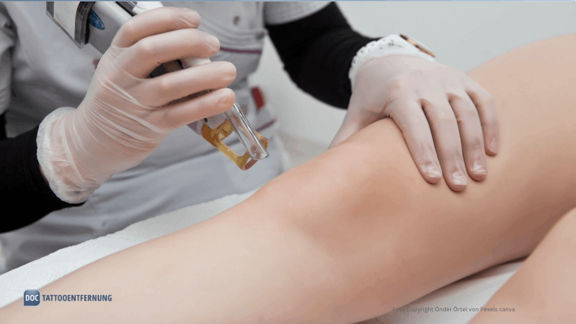 Blasen nach der Laserbehandlung zur Tattooentfernung Foto Copyright Önder Örtel von Pexels canva for DocTattooentfernung 2026