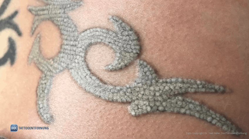 Frosting_Whitening_Popcorn-Effekt nach der Laser Tattooentfernung CAVITATION BUBBLES Foto Copyright Dr. Yael Adler und DocTattooentfernung 2026