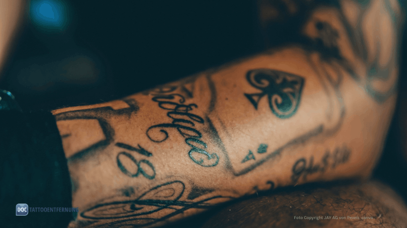 Tattoo Allergie Laser-Komplikation Foto Copyright JAY AG von Pexels canva for Doc Tattooentfernung 2026