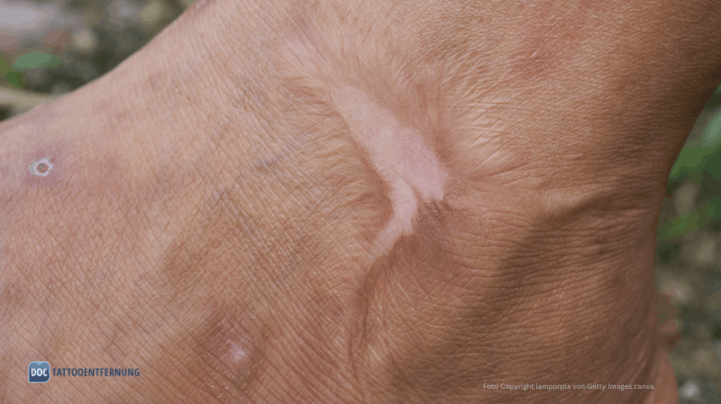 Verbrennung Narbe Symbolbild Foto Copyright iamporpla von Getty Images canva for DocTattooentfernung 2026