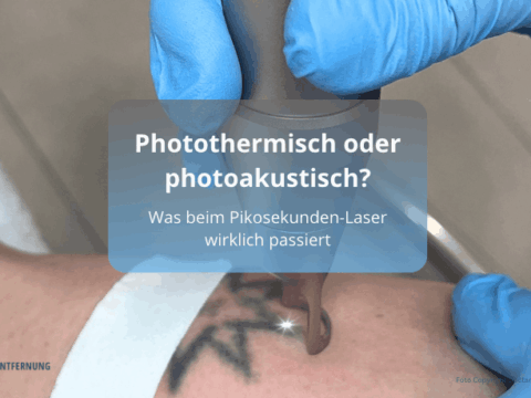 Photothermisch oder photoakustisch_ Was beim Pikosekunden-Laser wirklich passiert Foto Copyright Doctare GmbH Symbolbild for Doc Tattooentfernung 2026