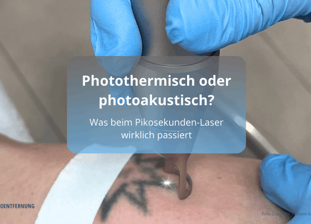 Photothermisch oder photoakustisch? Was beim Pikosekunden-Laser wirklich passiert