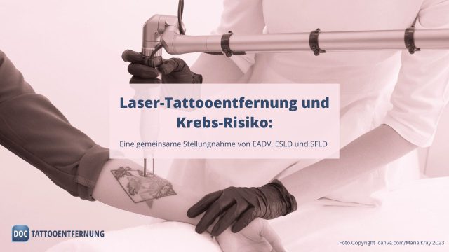 Laser-Tattooentfernung und Krebs-Risiko: Eine gemeinsame Stellungnahme dreier renommierter Derma-Fachgesellschaften.